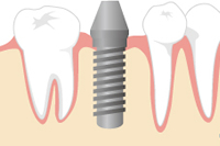 �񎟎�p�i�K�v�ȏꍇ�̂݁j